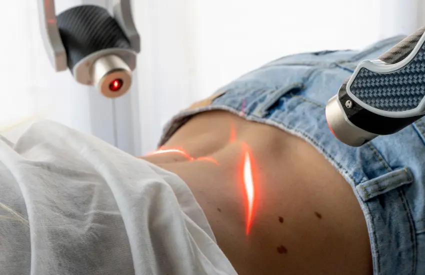 Laserterapia para hernia de disco ¿Es efectiva 2