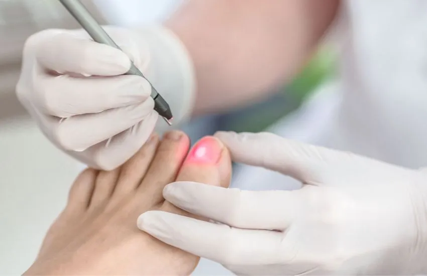 carmen moral aplicando laserterapia a la uñas dañadas