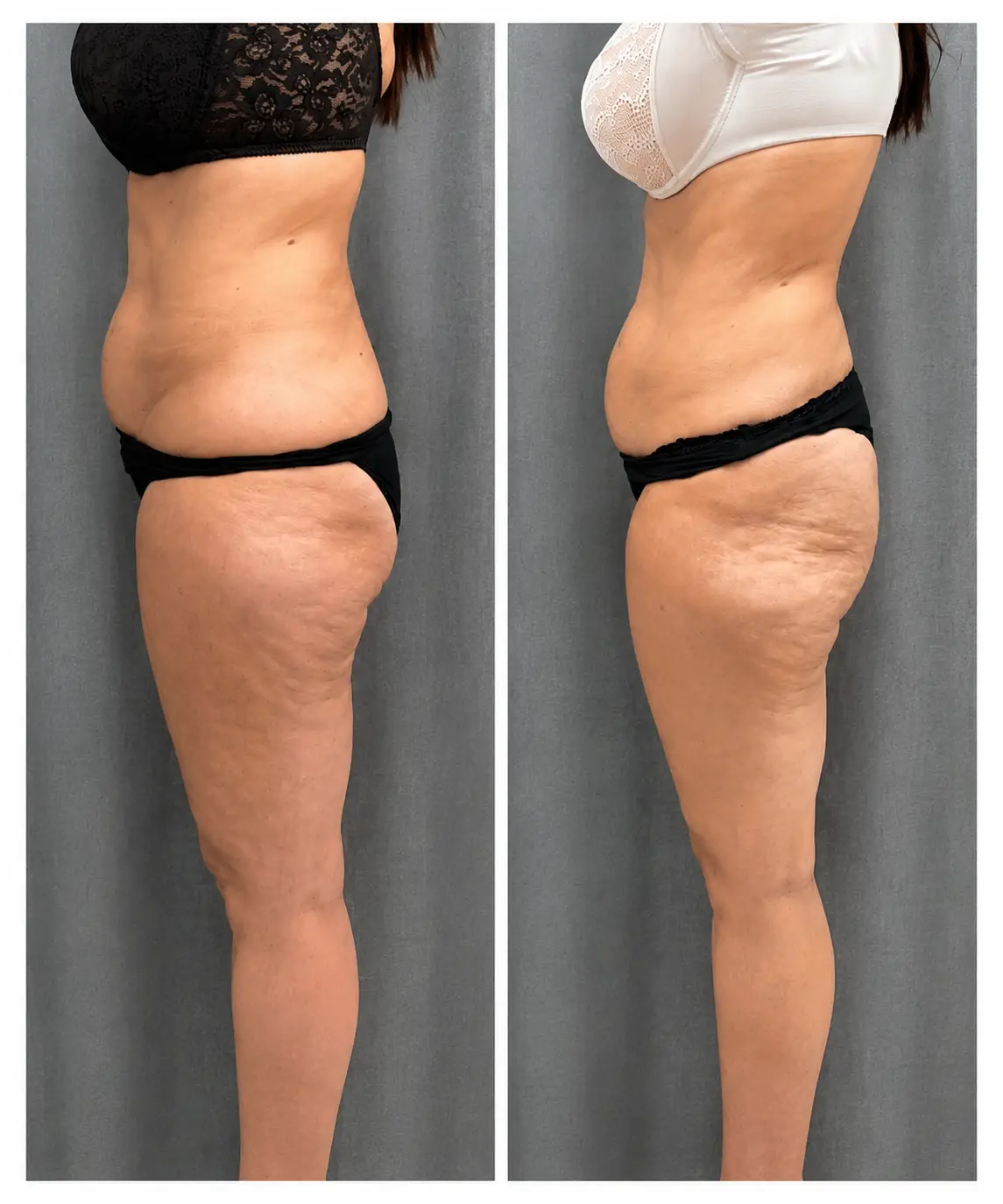 img-clinicalasermoral-emerald-antes-despues-1